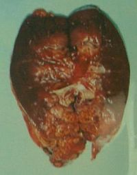 腎細胞癌（病期Ⅲ－Ⅳ）の予後に関する研究