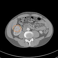 腎がんCT画像1